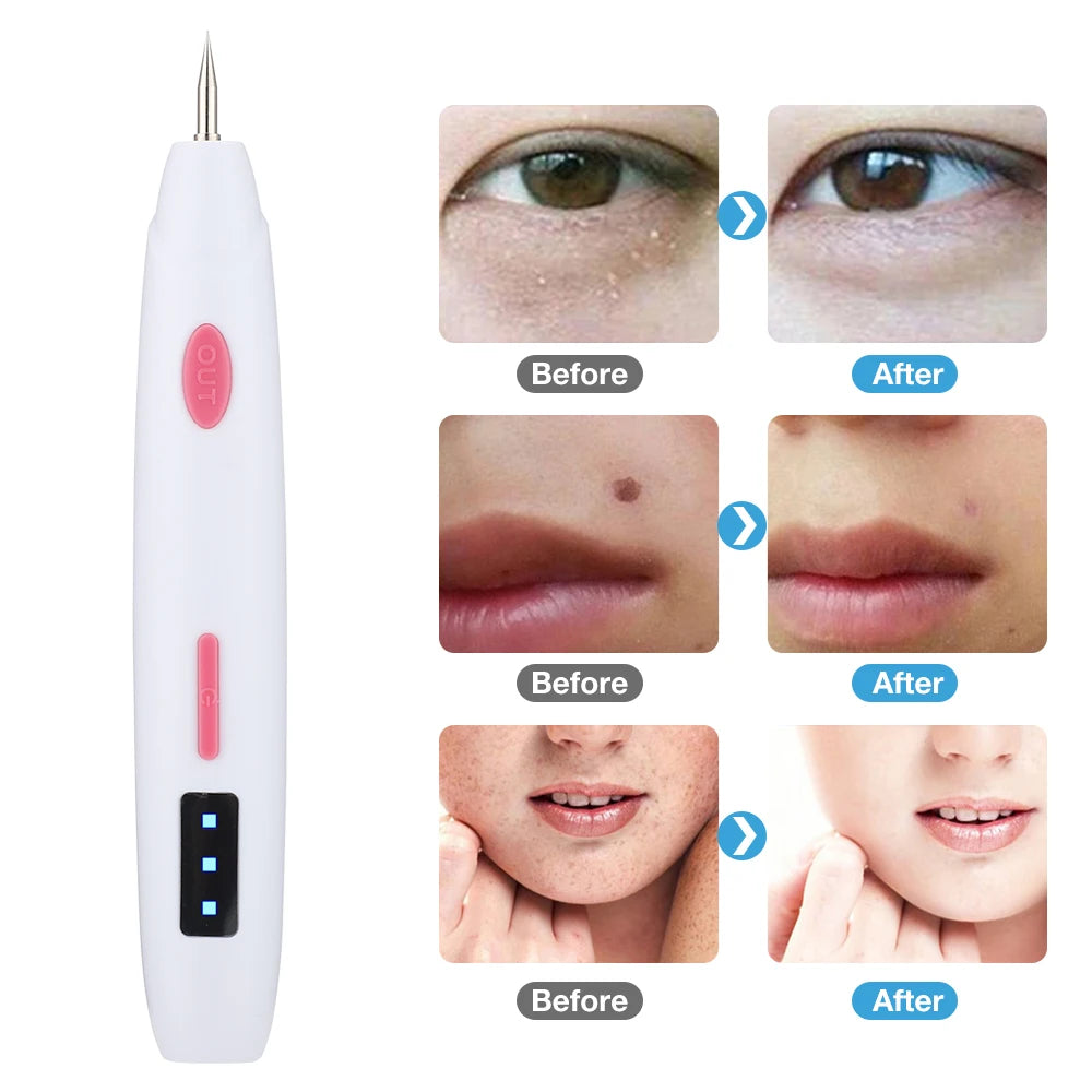 Electronic Blackhead Remover Pen