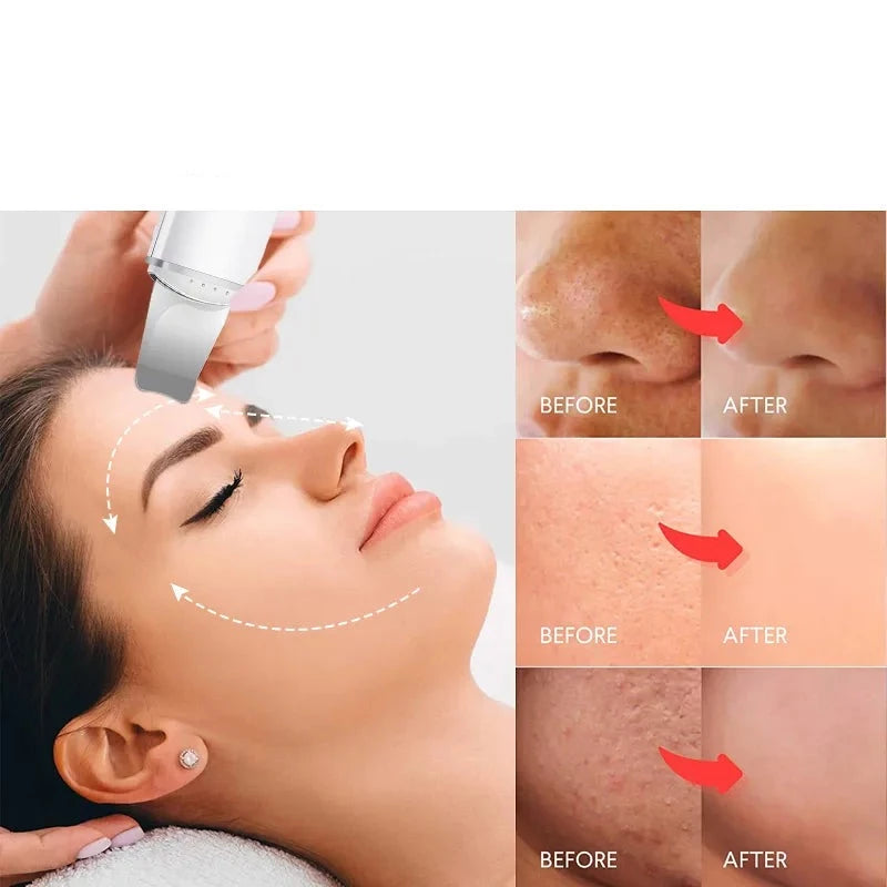 Ultrasonic Skin Scrubber